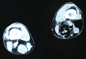 Tomografía computada de extremidad inferior izquierda: importante enfisema en extremidad inferior izquierda.