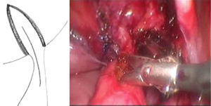 Incisión longitudinal del área ureteral estenosada.