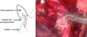 Anastomosis de la circunferencia anterior del uréter abierto a la mucosa vesical.