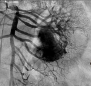 Arteriografía donde se canaliza arteria mesentérica superior y se observa la irrigación de la lesion, la cual depende de 2.a, 3.a y 4.a ramas yeyunales.