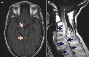 A) Resonancia magnética de cráneo, corte axial, secuencia T1 con gadolinio, en la que se observa lesión nodular (señalada con flechas) en cisterna interpeduncular y cisterna cuadrigémina, con reforzamiento de aracnoides alrededor del mesencéfalo. B) Resonancia magnética de columna cervical, corte sagital, secuencia T1 con gadolinio, en la que se observan lesiones perimedulares (señaladas con flechas) que refuerzan con contraste, irregulares, que generan compresión medular en su cara ventral y dorsal.