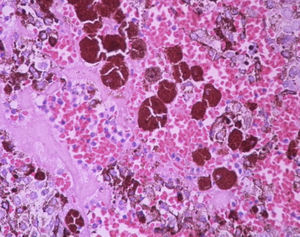 Imagen histopatológica, con presencia de células neoplásicas con citoplasma escaso, con nucléolo prominente y abundantes células grandes pigmentadas, denominadas melanófagos.