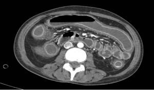 Imagen de la tomografía axial computada del caso clínico 1, donde se observa el edema, engrosamiento de la pared colónica, así como la pérdida de la haustración características de esta enfermedad.
