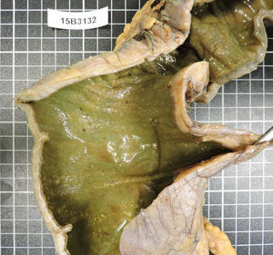 Imagen de la pieza quirúrgica del caso clínico 1, donde se visualizan las pseudomembranas características de esta enfermedad en la pared del colon.