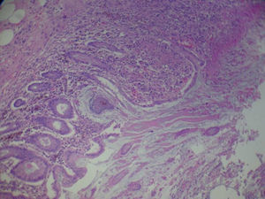 Imagen microscópica de la pieza quirúrgica del caso clínico 2, donde se observa la histología de las pseudomembranas (tinción hematoxilina-eosina).