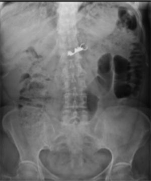 Caso 2. Radiografía AP de abdomen. Imagen compatible con puente dental. Día uno de ingesta.