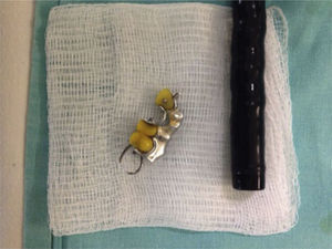 Prótesis dental con colonoscopio, posterior a su extracción.