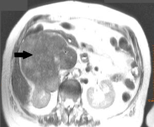 Tomografía axial computada abdominal, donde se aprecia la gran tumoración retroperitoneal que envuelve riñón derecho y la vena cava inferior.