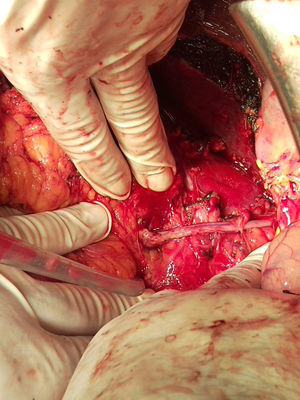 Imagen del bypass con safena entre la vena renal izquierda y el muñón proximal de la vena cava inferior.