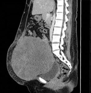 Tomografía axial computada contrastada de abdomen. Muestra tumoración sin datos de infiltración a estructuras adyacentes, en contacto con el útero, anexo izquierdo, vejiga y pared abdominal (corte sagital).