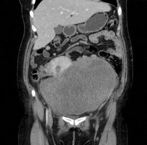Tomografía axial computada contrastada de abdomen. Muestra tumoración con bordes bien definidos con discreto realce al material de contraste (corte coronal).