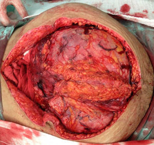 Tumoración intraabdominal durante la laparotomía.