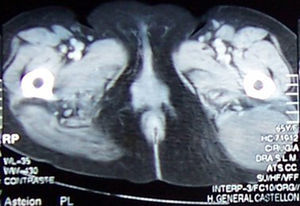 Tomografía axial computada. Masa bien circunscrita de 8×6cm, hipodensa y sin realce tras inyección de contraste en el seno del glúteo mayor.
