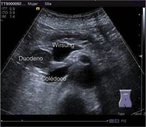 Ultrasonido abdominal en el que se aprecia dilatación del conducto pancreático principal y del conducto colédoco.