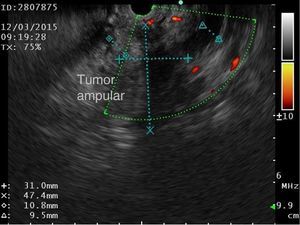 Ultrasonido endoscópico en el que se aprecia dilatación del conducto pancreático y se aprecian las dimensiones del tumor ampular.