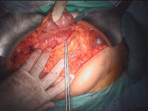 Fotografía intraoperatoria. Se aprecia la lesión tumoral de consistencia blanda de 1cm de diámetro, situada en cuerpo páncreas.