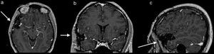 Resonancia magnética de cráneo postoperatoria que muestra resección completa del tumor: a) corte axial, b) corte coronal, c) corte sagital.