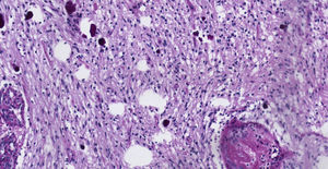 Astrocitoma pilocítico. Áreas piloides conformadas por células fusiformes bipolares con algunas fibras de Rosenthal y calcificaciones (aumento de 10x, tinción hematoxilina y eosina.