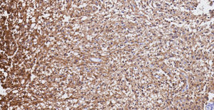 Astrocitoma pilocítico. La inmunorreactividad para proteína ácida fibrilar glial (GFAP) es muy intensa en las prolongaciones de las células neoplásicas (aumento de 10x. Inmunohistoquímica).