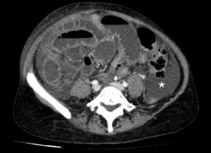 Imagen axial de la tomografía computada abdominal con contraste intravenoso. Dilatación de asas de delgado y presencia de líquido ascítico (asterisco). Posición anormal del ciego, localizado en línea media (flecha).
