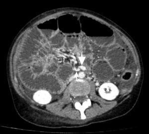 Imagen axial de la tomografía computada abdominal con contraste intravenoso. Inversión de la posición de los vasos mesentéricos, con artería mesentérica superior (flecha fina) localizada a la derecha de la vena mesentérica superior (flecha gruesa).