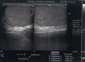 Ultrasonido doppler de testículo izquierdo sin evidencia de flujo y ausencia de saturación de las estructuras vasculares.