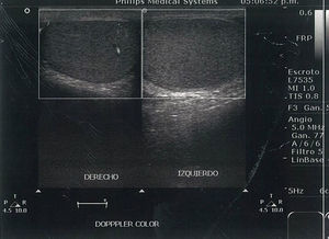Ultrasonido doppler que compara flujo vascular en ambos testículos.