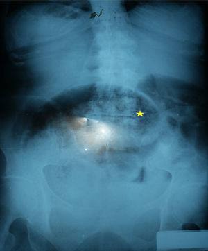 Radiografía de abdomen con datos sugerentes de volvulación (estrella).