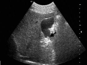 Hígado con patrón ecográfico grueso, sugestivo de proceso inflamatorio crónico. Se observa imagen isoecogénica a la pared, con relación a probable pólipo en cuello de 14mm (flecha).