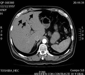 Imágenes hipodensas (flechas), con respecto a parénquima hepático, que no refuerzan con la aplicación del medio de contraste. Aumento en la densidad de parénquima hepático.