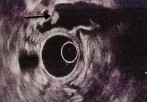 Lesión hiperecogénica en su superficie, de 10mm, que no proyecta sombra acústica posterior, la cual puede corresponder a pólipo vesicular vs. lodo biliar (flecha).