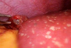 Múltiples lesiones en toda la extensión de hígado, sugestivas de carcinomatosis, además de quistes hepáticos simples.