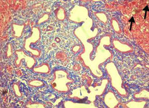 Imagen microscópica con técnica de Masson, donde se observan hamartomas biliares y corpúsculos grasos, en parénquima hepático (flechas) (tinción tricrómica de Masson; aumento 10×).