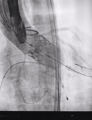Control angiográfico para corroborar la posición adecuada de la prótesis y determinar la presencia o ausencia de fuga paravalvular, que además se comprueba por ecocardiografía.