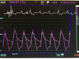 Tratamiento de la estenosis valvular aórtica con implante de prótesis ...