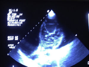Imagen ecocardiográfica donde se visualiza el aumento de volumen de la pared ventricular.
