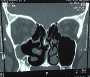 Tomografía simple corte coronal donde se observa la asimetría de ambos senos maxilares, con colapso del seno maxilar derecho, hipoglobus y la implantación anómala del cornete medio.