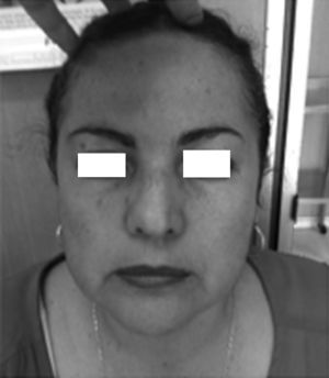 Fotografía clínica de la paciente con la asimetría facial discreta a expensas de hipoglobus izquierdo.