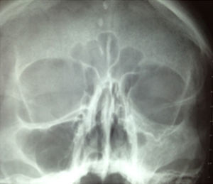 Radiografía de Waters simple donde se observa asimetría con hiperdensidad a nivel del seno maxilar izquierdo con reforzamiento óseo e hipoglobus.