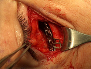 Fotografía transquirúrgica en que se observa la colocación de placa de titanio previa a la fijación con tornillos para corrección de diplopía.