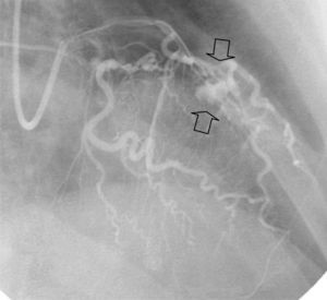 Active extravasation of contrast at the middle portion of the anterior descending coronary artery (arrows) during the percutaneous coronary intervention.
