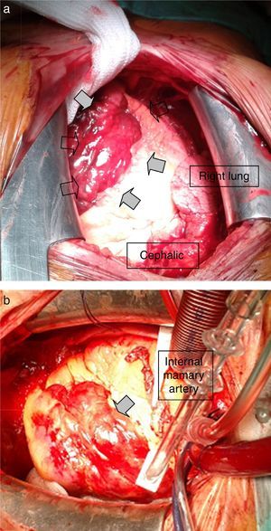 (a and b) Operative images of a large sub-epicardial hematoma (arrows) caused by perforation of the anterior descending coronary artery.