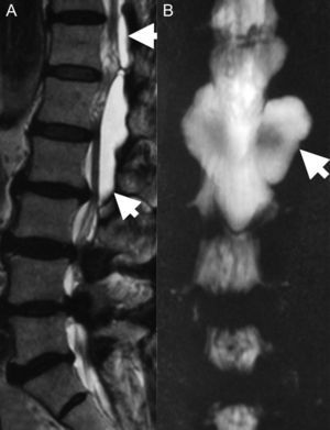 A. Imagen de resonancia magnética en secuencia T2; se observa una lesión quística isointensa con el líquido cefalorraquídeo (flechas) de T12 a L2. B. Efecto mielográfico en imagen de resonancia magnética; es notoria la comunicación (flecha) entre el espacio aracnoideo y la lesión quística.