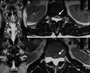 A. Corte coronal en secuencia T2 de imagen de resonancia magnética donde se aprecia la extensión foraminal del quiste (asterisco) en T12-L1 y L1-L2. B. Corte axial de imagen de resonancia magnética en secuencia T2 del nivel T12 en donde se observa el desplazamiento ventral del cono medular (flecha) ejercido por el quiste. C. Corte axial de imagen de resonancia magnética en secuencia T2 del nivel L1 en donde se observa compresión de la cauda equina (flecha) ejercida por el quiste.