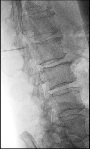 Imagen fluoroscópica transoperatoria lateral de L1-L2 durante la punción evacuatoria del quiste.