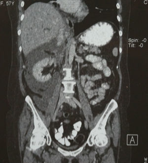 Tomografía axial computada: corte coronal, abundante líquido perirrenal.
