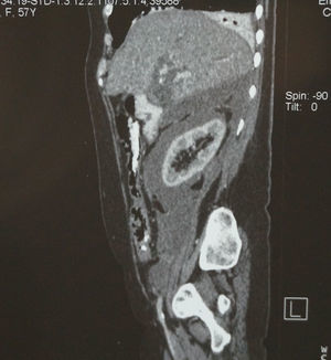 Tomografía axial computada: corte sagital, líquido perirrenal.