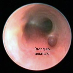 Broncoscopia en donde se aprecia la emergencia del bronquio traqueal por arriba de la carina.
