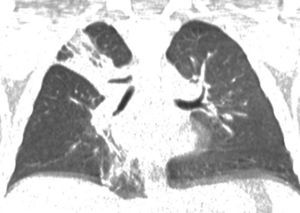 Corte de la tomografía simple de tórax en donde se aprecia la salida anómala del bronquio apical derecha.