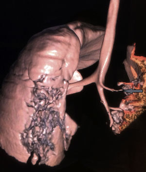 Reconstrucción de la tomografía de tórax en donde la flecha señala la emergencia anómala del bronquio apical derecho.